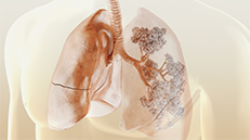 medizinische 3D Animation Patientenfilm Lungenfibrose Atemwege, Patientenaufklärungsfilm Pharma