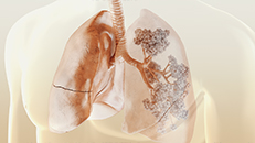 3D-Animation Medizin Lunge Atemwege Bronchiolen Alveolen COPD 