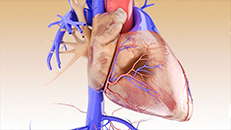 3D-Animation Herz nach Myokardindfarkt, Medizintechnik Kardiologie