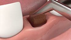 Zahnmedizin 3D-Animationsfilm Wundversorgung im Mund