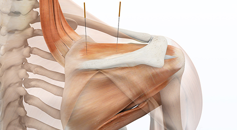 3D-Illustration Schulter Akupunktur Orthopädie